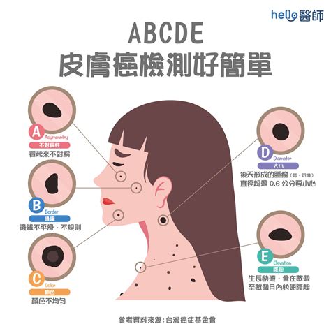 下巴痣長毛|痣形成的原因？痣長毛、痣變多變大是痣病變？5招判。